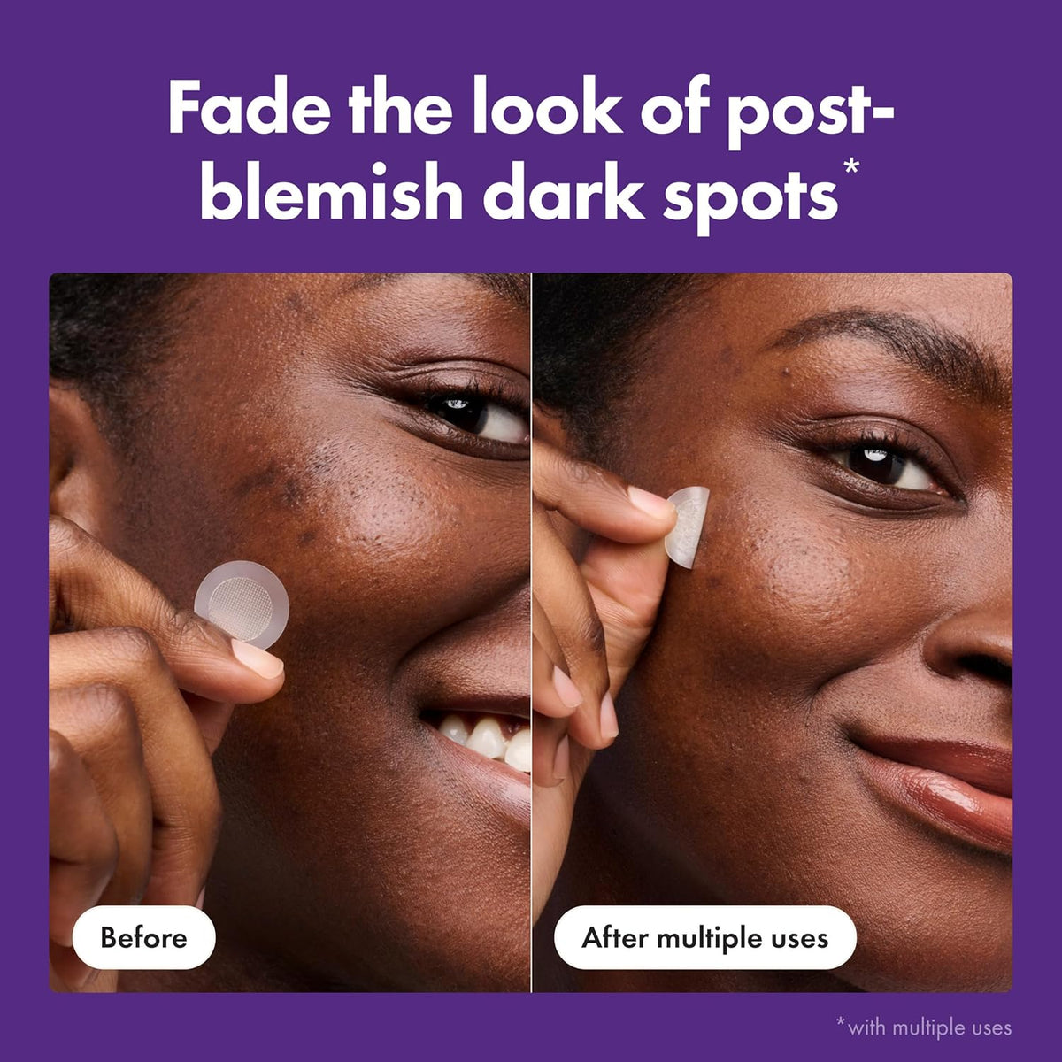 BRAND NEW ~ 8 Mighty Patch Hero Cosmetics Micropoint™ Post Blemish Dark Spots